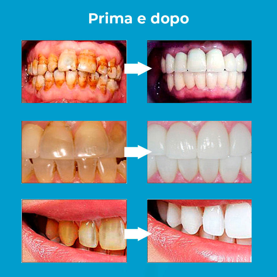 Matita Sbiancante per Denti: Offerta 2x1